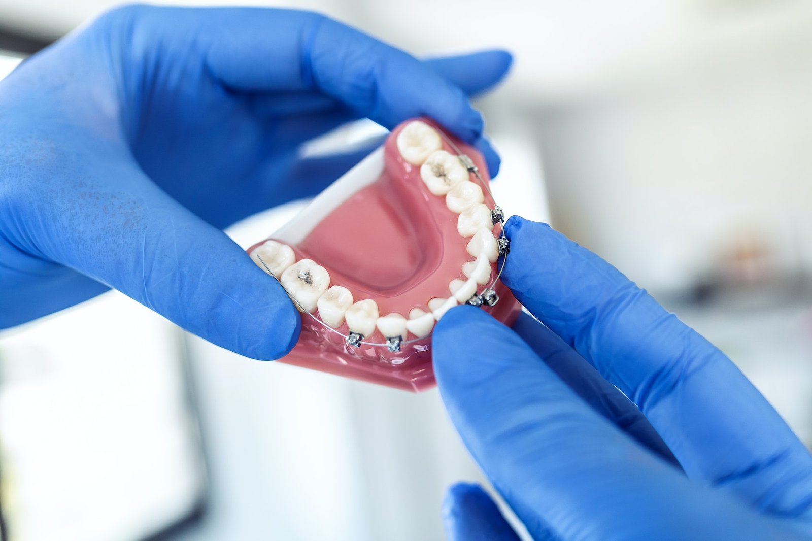 doctor holds an artificial model of the jaw with invisible braces.