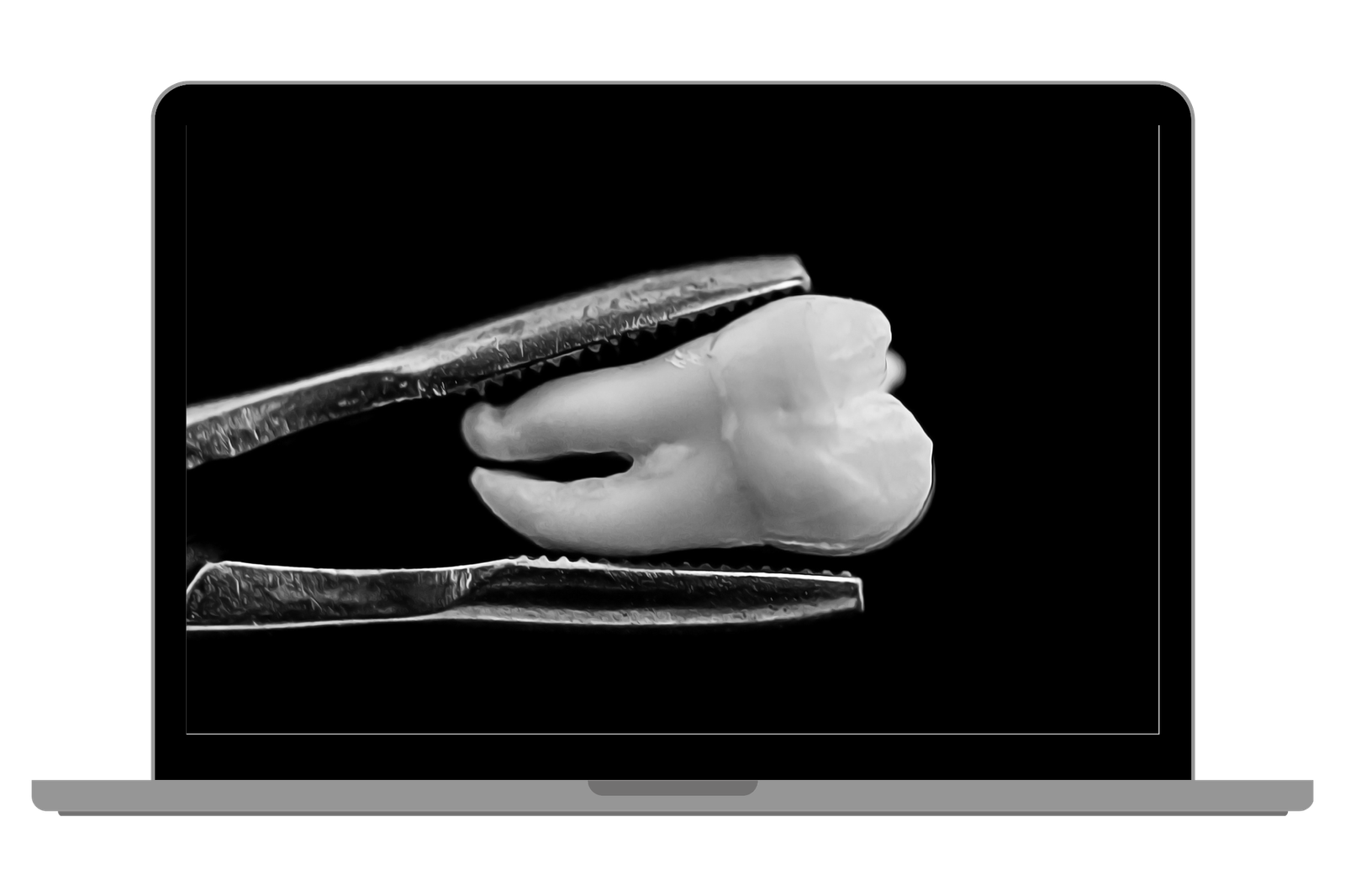 EXTRAÇÃO DENTÁRIA: Quais os cuidados após?