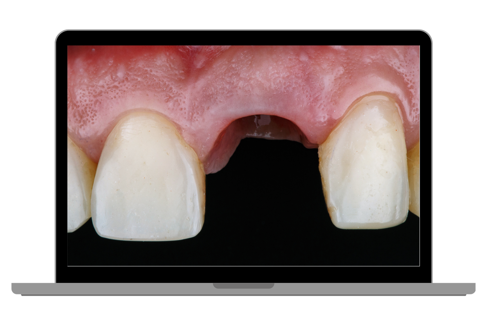 FALTA DE DENTES: Quais os problemas associados?